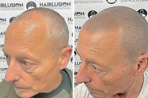 Who is Scalp Micropigmentation Suitable For