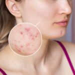 Fungal Acne