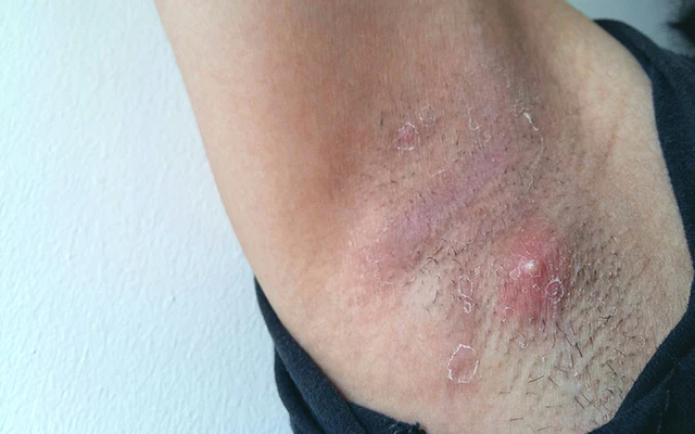 The Definition of Armpit Pimple