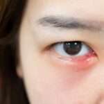 A woman with a pimple on eyelid or eye stye